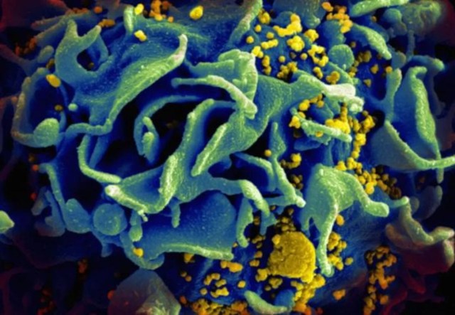 11▲HIV（黄色颗粒）感染表达CD4的免疫T细胞（图片来源：NIH）.jpg