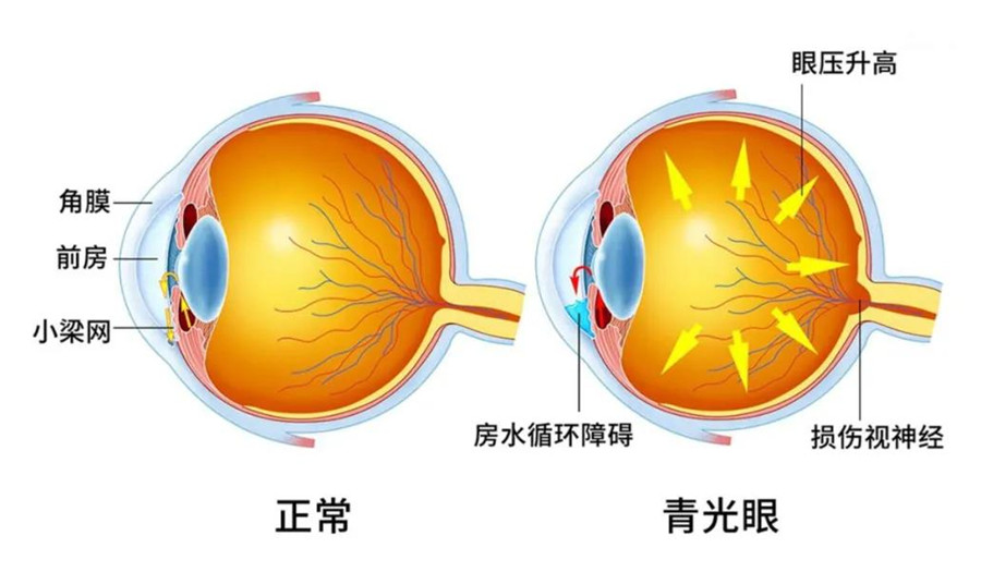 青光眼无法治愈？哈佛团队：干细胞可再生视网膜细胞，恢复视力长达1年！