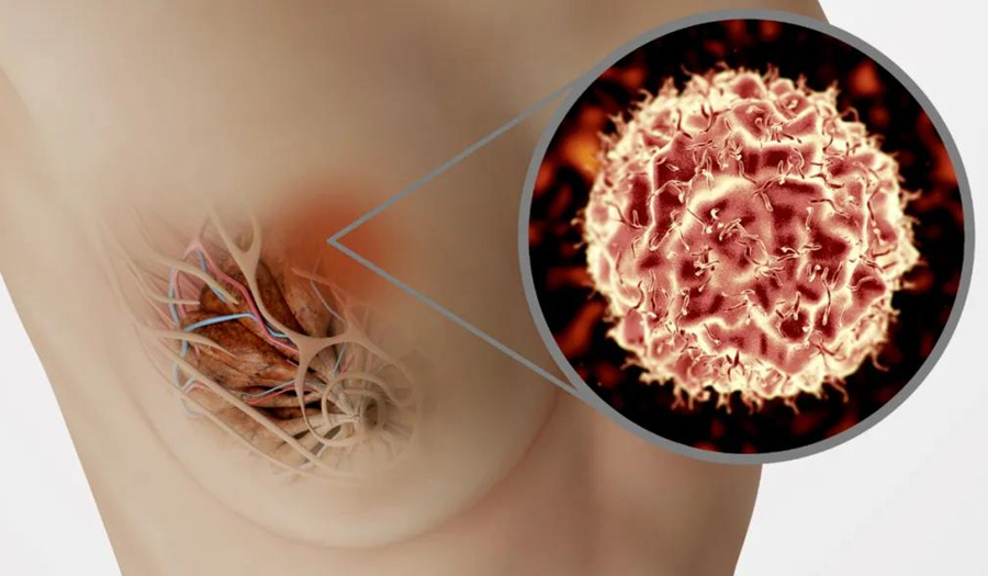 NK细胞免疫疗法，让乳腺癌细胞无处可逃