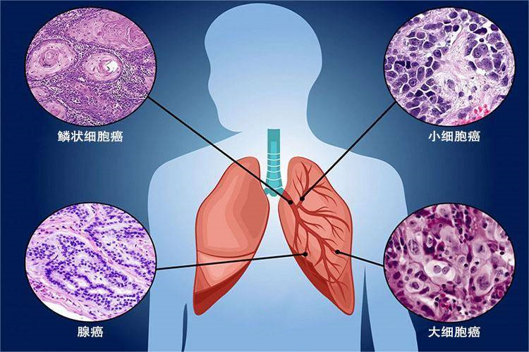 CIK细胞免疫疗法，让肺癌患者摆脱化疗之苦