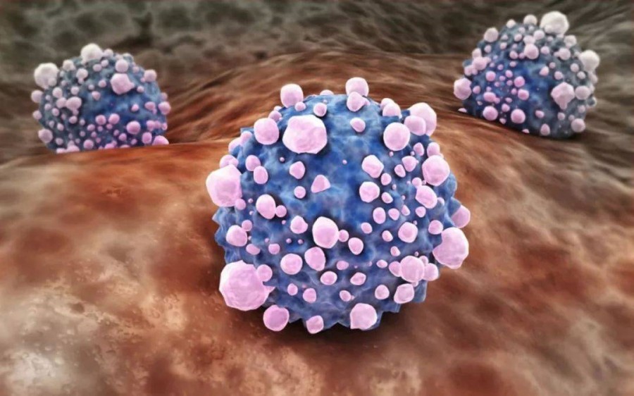 1423人参试临床表明：NK细胞在肿瘤微小病灶治