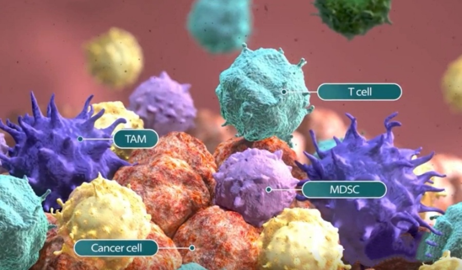 案例 | 6次自体NK免疫细胞输注，61岁肺癌患者生活质量明显改善